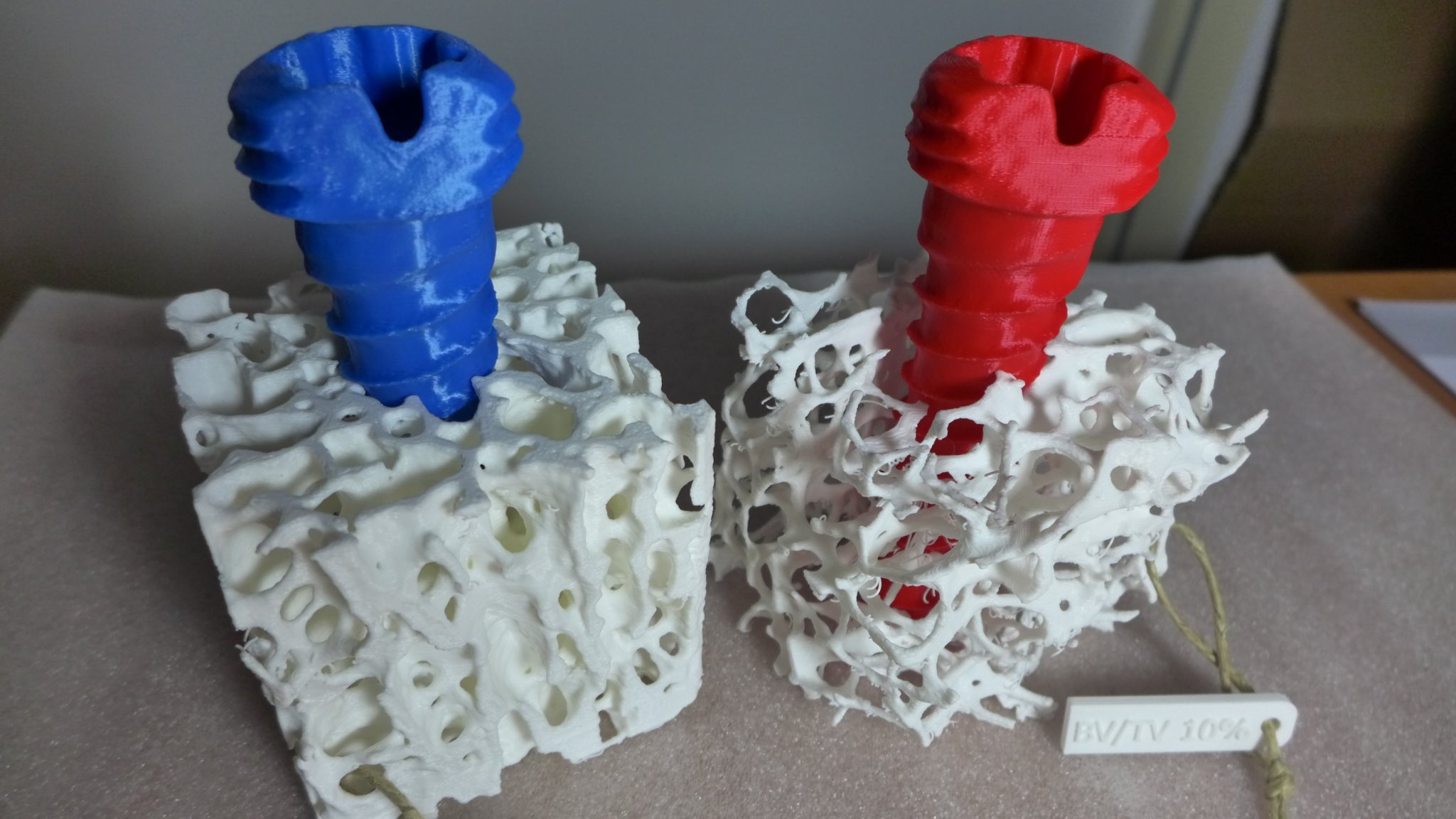 Mô hình xương bè loãng xương kèm vít xương