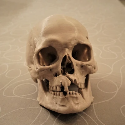 Hộp sọ người với chấn thương chiến tranh (bản quét 3D; Historiska Museet 260727)