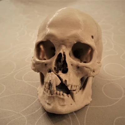 Hộp sọ người với chấn thương chiến tranh (bản quét 3D; Historiska Museet 260727)