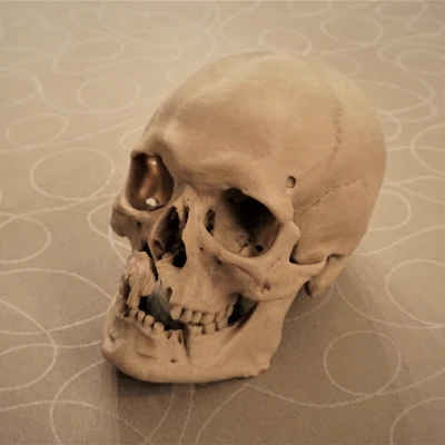 Hộp sọ người với chấn thương chiến tranh (bản quét 3D; Historiska Museet 260727)