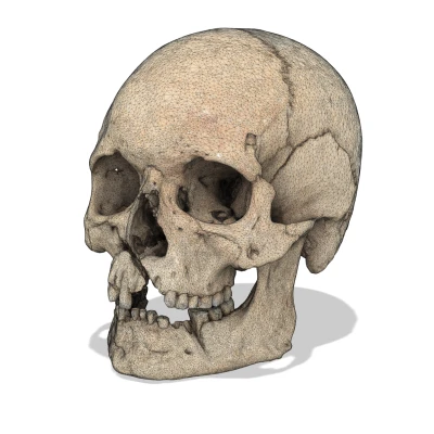 Hộp sọ người với chấn thương chiến tranh (bản quét 3D; Historiska Museet 260727)