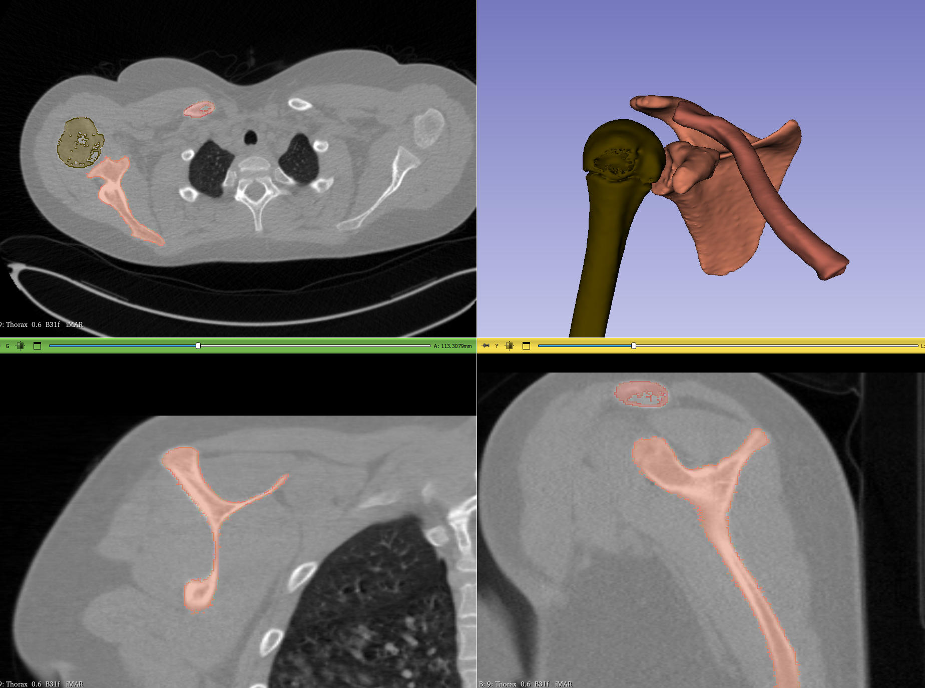 Xương Vai Phải - Mô Hình 3D Dễ In