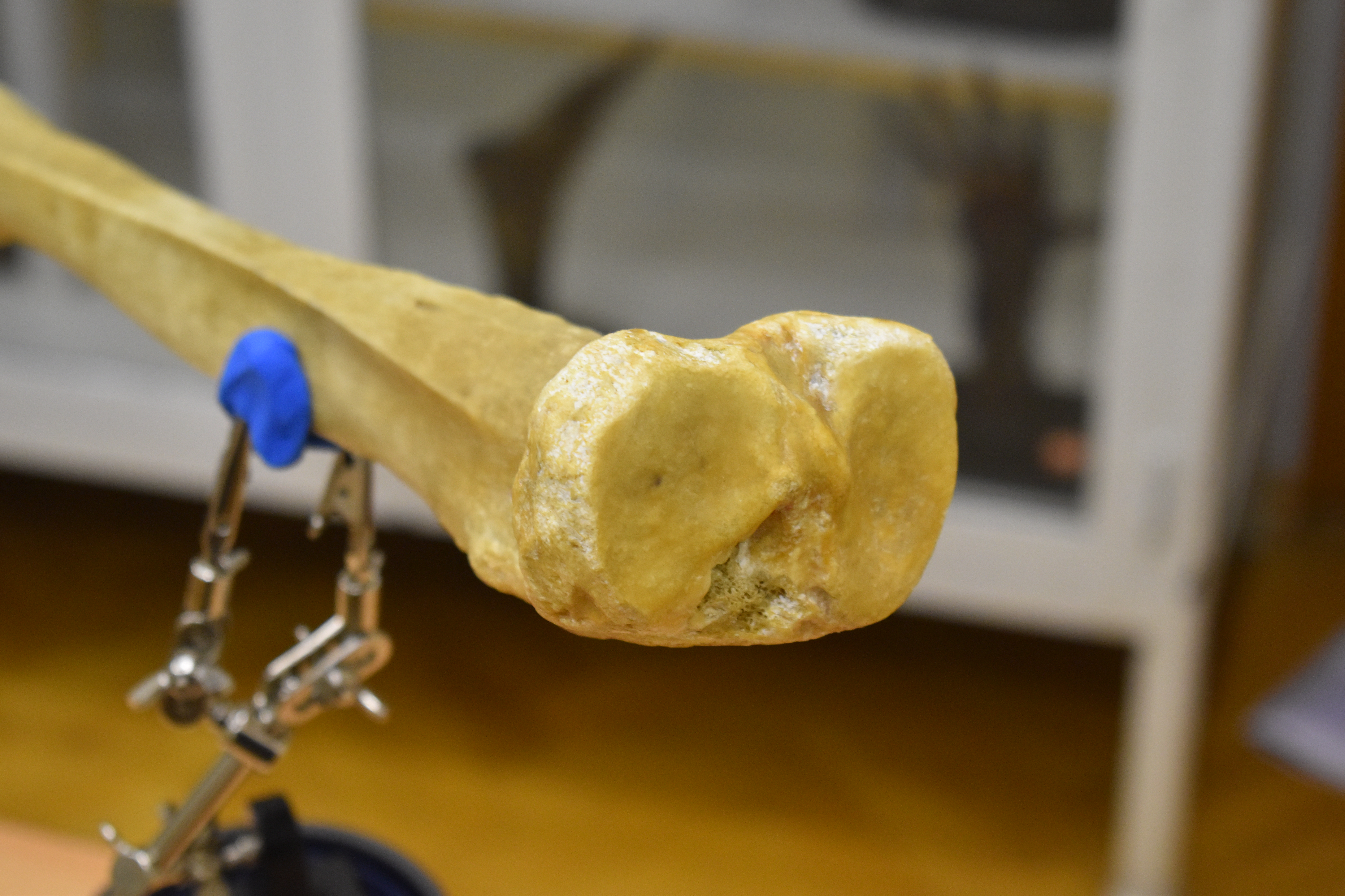 Xương chày - Shinbone Scan - Tibia