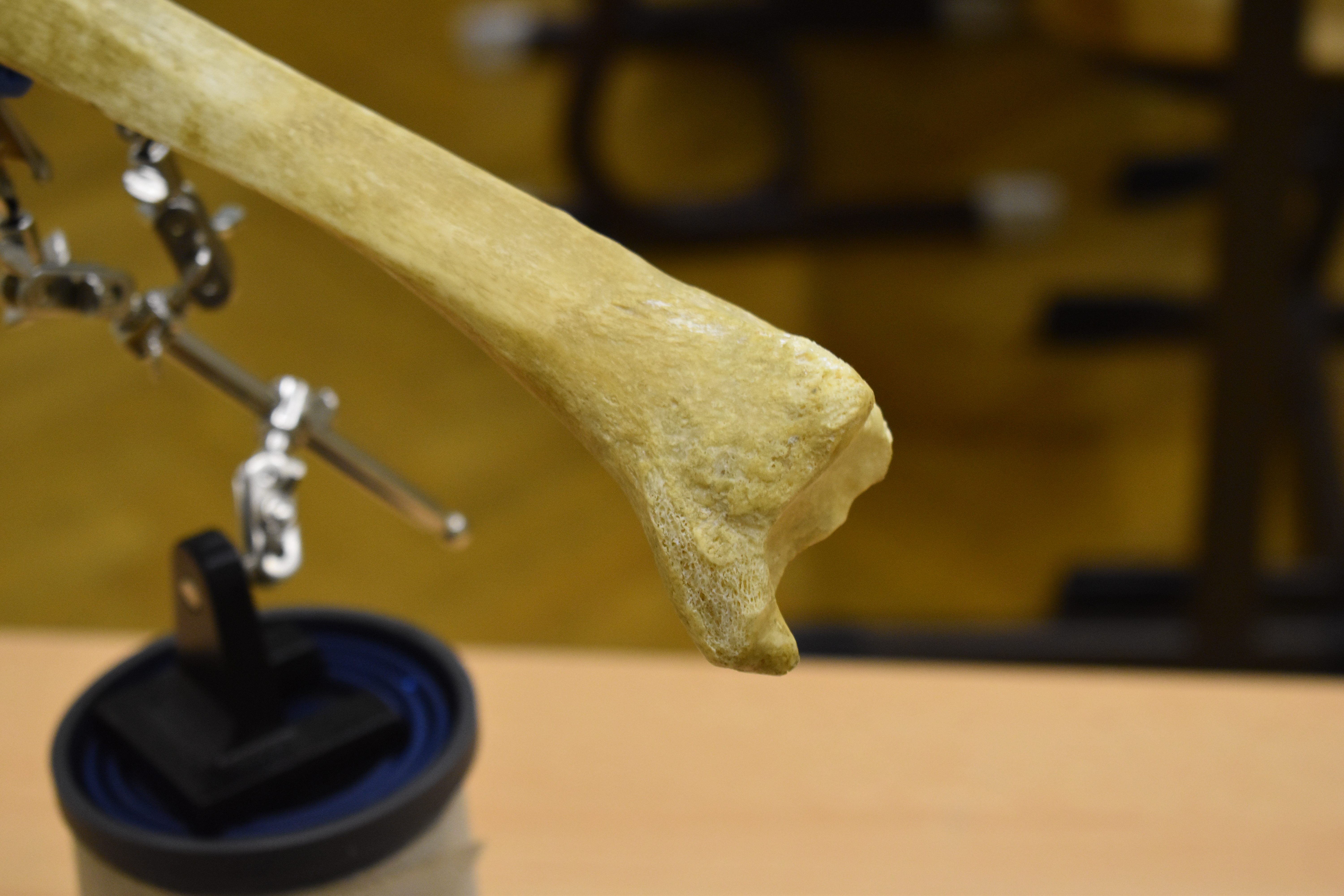 Xương chày - Shinbone Scan - Tibia