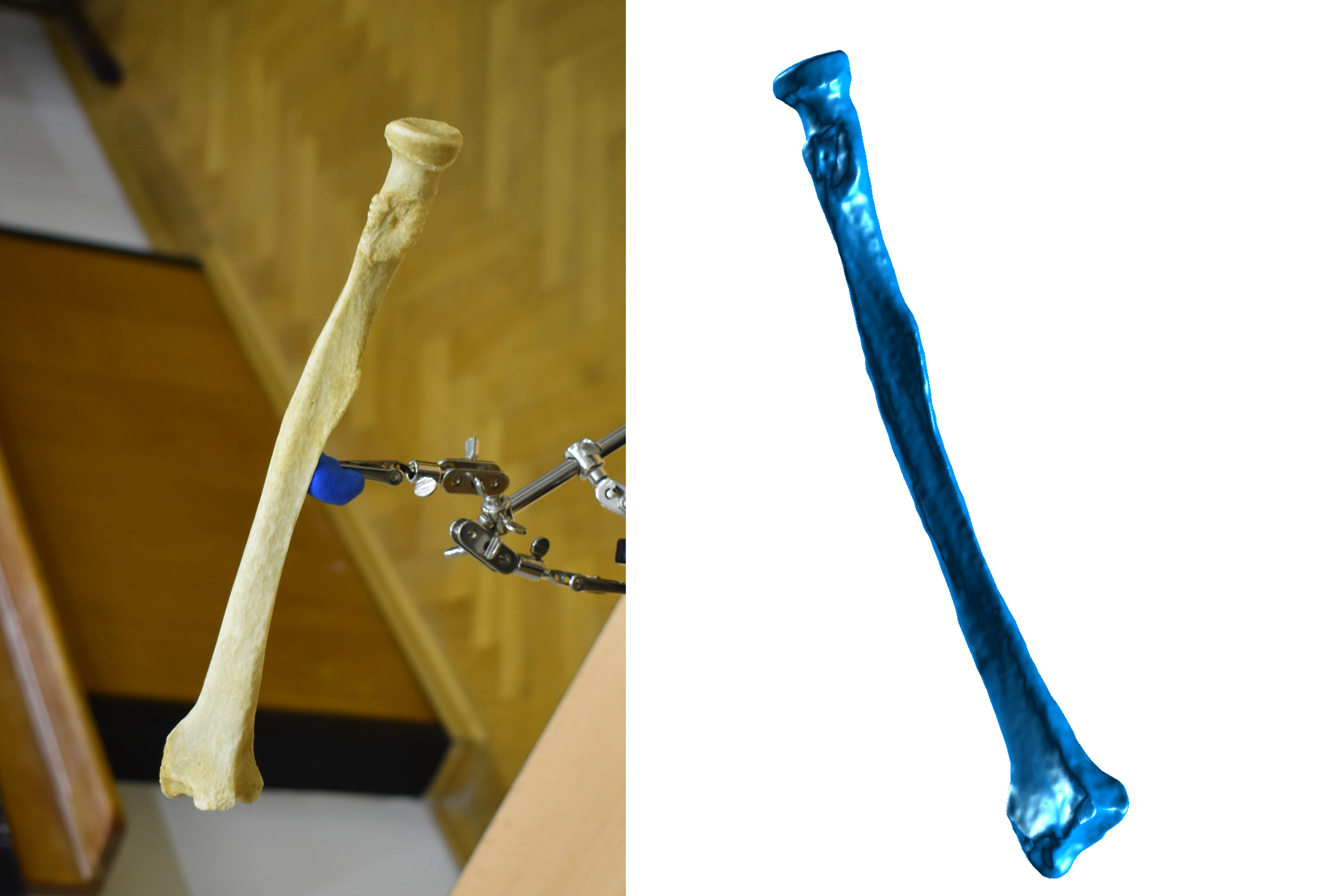 Quét 3D Xương Cẳng Tay - Xương Trụ