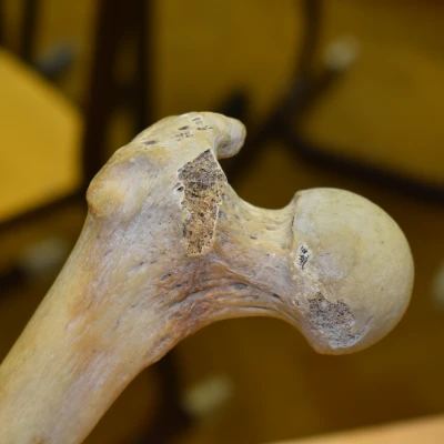 Xương Đùi (Femur) Quét 3D