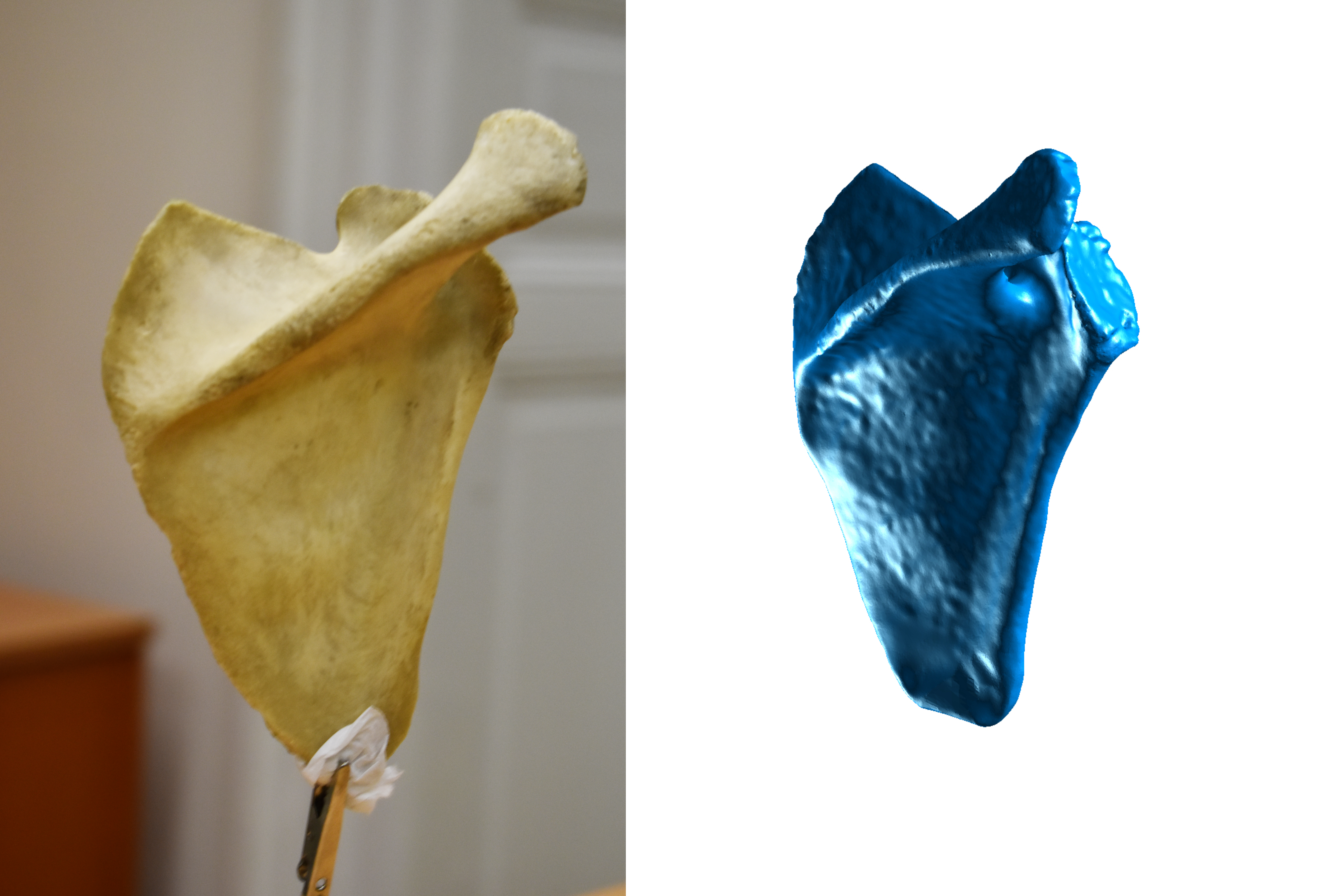 Xương Vai - Scapula (Bản Scan 3D)