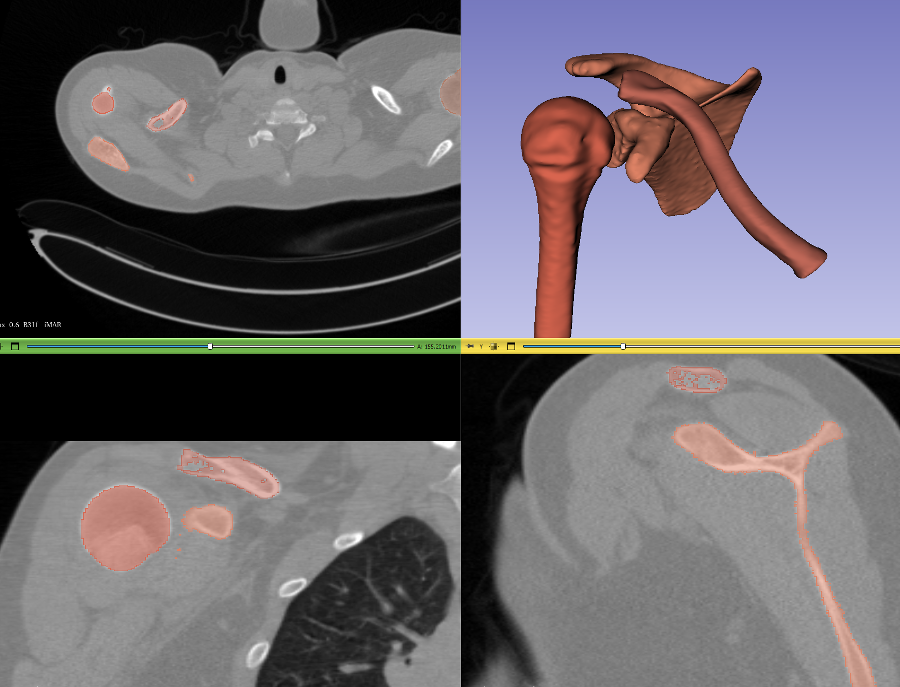 Xương Đòn Trái (Clavicle Left)