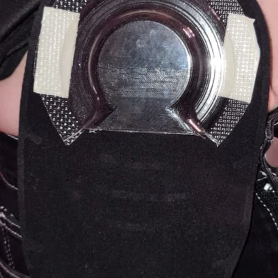 Nắp Giữ Tràng Ruột Sa / Prolapse Containment Cap for Intestinal Stoma